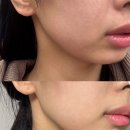 김포 사우동피부과 써니리프팅 2주차 통증 및 효과 후기