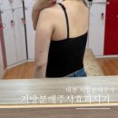 시기 | 대전 팔뚝 지방분해주사 성분과 효과 시기 솔직후기