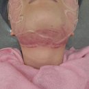 구월공 피부과 인모드 슈링크 유니버스 차이 심한 멍 후기 미래에 나는 보아라