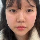 행복한제이피부과의원 | 선릉역 피부과 골드제이의원 | 티타늄 리프팅·쥬베룩볼륨·볼패임 시술 솔직 후기