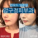 멍스타일 | 압구정역피부과 인모드 후기 부작용 가격 멍 붓기 효과 내돈내산