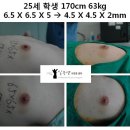 [남성유두축소수술전후] 25세 학생 170cm 63kg 6.5 X 6.5 X 5 → 4.5 X 4.5 X 2mm 이미지