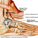 발 통증과 재활① 급성관절 염좌 (acute ankle sprain) 및 발목 관절부 골절 이미지