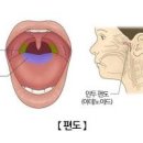 편도염 빨리낫는법 편도염 음식 원인 급성편도염 이미지