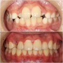 최윤정치과의원 | 5년전 소아교정, 인비절라인 퍼스트 로 진행 했더라면. 어린이교정 최신 지견 변천사