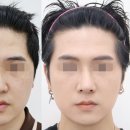 [남자코성형] 자가늑연골로 자연스럽고 세련되게! 성품성형외과 남자 코 성형 리얼 후기