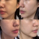 서울밸런스의원 | 강남구청역피부과, 줄기세포주사로 유명한 곳 이노벨의원 내돈내산 후기