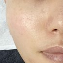 울산 한의원ㅡ새살침 수두 치료