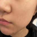 에이오의원 | [강남 에이오클리닉]여드름 흉터 고민이라면..이리오세요