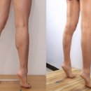 하나초음파테크 | #31. 2026 종아리 성형의 진화: AI 예측부터 초음파 정밀 진단, 맞춤형 압박복까지