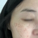 울산 피부관리 주근깨 기미 레이저 시술 후기 (공장형 피부과와 개인피부과 차이)