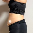 나의 다이어트 일지 팔뚝 복부지방분해주사 용량 부작용 가격 7차 후기