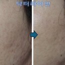 (주)프락시스 | 울트라펄스알파 200명 여드름흉터 치료 후기ㅣ울트라펄스앙코르와 결정적인 차이점(시술사례)