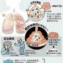 마른 기침, 숨이 차는 것은 간질성 폐렴일지도…일반적인 폐렴과는 어떻게 다른가？ 이미지