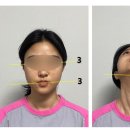 동그라미한의원 | 안면비대칭교정 한의원 찐후기 가격과 효과는 연예인 어디?
