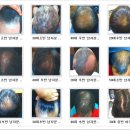 이성미베스트의원 | 평택탈모 관리가 중요한것 같습니다.