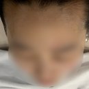 [평택] 평택 SMP 드라마티크 에서 M자 헤어라인 받은 찐 후기!!
