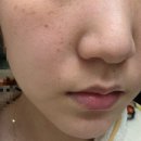 에이피부과 | eoa(이오에이) 풀텐자 내돈내산 사용후기(메디큐브 부스터프로 비교)
