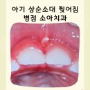 삼성에스치과의원 | 아기 상순소대 찢어짐 병점 소아치과 방문 후기