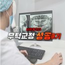 바른웅치과의원 | 무턱교정 성공후기 발치없이 얼굴윤곽 개선하기.