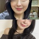 디파인피부과의원 | 볼륨 | 레디어스 내돈내산 6개월까지 찐 후기 <디파인 피부과의원> | 쥬베룩 볼륨, 스컬트라, 레디어스...