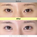 순한의원 - 성남시 분당구 돌마로 47 | 답답하고 사나워보이는 꼬막눈, 써클트임으로 순한 고양이상 눈매 완성 후기(하니성형외과)