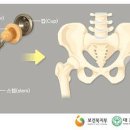 6대인공관절치환수술(연간1회한)보장 특별약관 이미지