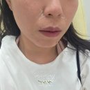 화이트라인의원 | 신촌피부과 추천｜유온느의원 쥬베룩볼륨 후기 – 팔자주름 효과 솔직 리뷰