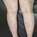 가야한의원 | 부산두드러기한의원? 약 종류는 늘어나도 잠 못들 정도로 가려운 분들게 드리는 편지.