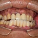 의정부제일치과의원 | 의정부신곡동치과 어금니 치아가 빠진 채 오래 두면? 교합 불균형, 임플란트에서 중요한 것!