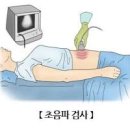 급성 충수염 , 원인 및 수술 (오른쪽 아랫배 통증) 이미지