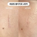 누가한의원 | 부산 흉터치료 한의원 새살침 효과 내돈내산 후기 여드름흉터치료 추천