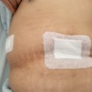 인천더드림병원 | 인천 담낭수술 병원 추천/ 인천 더나눔병원/ 담석제거수술 입원후기 /인천담석제거수술/ 인천 담낭제거...