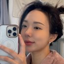 소세지눈 재수술 후기 두달차 2달차 전후사진 잔뜩 보러오시오