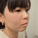 치유본의원 | 40대에도 다시 어려지다! 내 피로 되살아난 피부, MTS+자가혈 재생 시술 리얼 후기