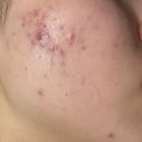 피부맑음 에스테틱 | [의정부] 호원동 에스테틱 맑음뷰티 문제성피부