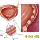 방광암 암보험금 지급여부..... 이미지