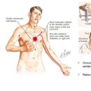 Ch 36 Stable Angina 이미지