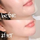 쑥티마을 | 얼굴 붓기 관리 꿀템 티마뷰티 실리콘 리프팅밴드 리얼 사용 후기