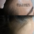 안양 평촌 수기브로우 두피SMP 헤어라인 만족 후기