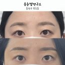 송신경정신과의원 | 신대방삼거리 송눈썹연구소 두번째 방문 눈썹반영구 후기 :)