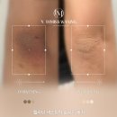 [르멜라X투미쓰왁싱구파발점] 팔꿈치착색 멜라닌 색소침착 케어 후기 _ 은평구 구파발 지축 삼송 왁싱