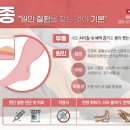 다리 부종 원인 다리 붓기 원인 다리 부기 원인 다리가 붓는 이유 다리 붓기 빼는 방법 이미지