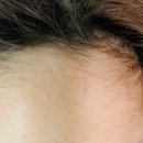 미래어린이병원 | 어린이 여드름, 아토피 진료 후기 전주 미래피부과