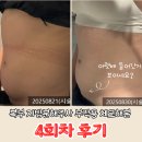 4 | 복부 지방분해주사 부작용 체크해본 4회차 후기