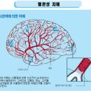 혈관성 치매 이미지