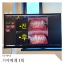 신사역 5번출구 신사역치과 서울센텀치과 치아 미백후기