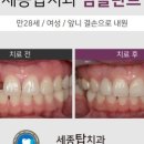 세종탑치과 네이버블로그