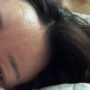 라인의원 | 구월동 피부과 리쥬란 맥스 맞고온 후기 VS라인의원 인천구월점