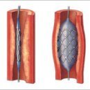 관상동맥 스텐삽입 시술 이미지
